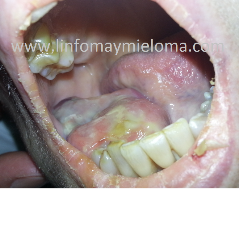 Plasmocitoma mandibular durante una recaida en un paciente de mieloma